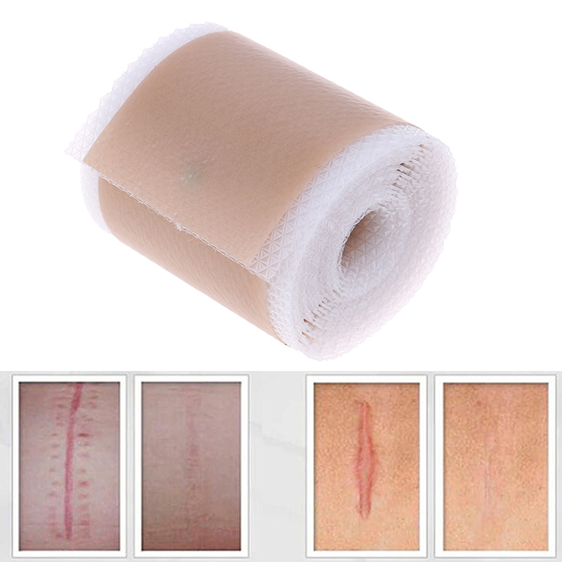 Efficient Surgery Scar Removal Silicone Gel Sheet Therapy Patch for Acne Trauma Burn Scar Skin Repair Scar Treatment 4x150cm