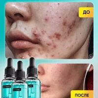 Набор от прыщей и акне