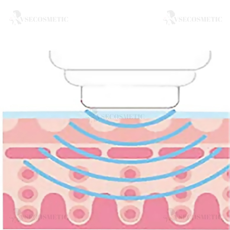 Ультразвуковой режим (укрепление кожи)