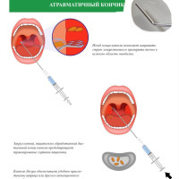 Шприц для промывания миндалин и горла, комплект 1 канюля и на 10 мл2 шт.